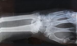 An x-ray of a wrist